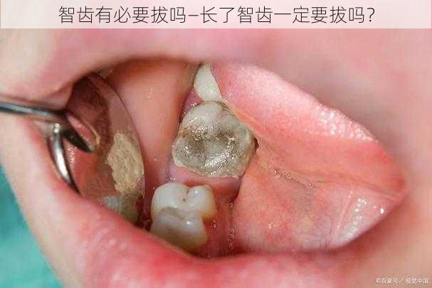 智齿有必要拔吗—长了智齿一定要拔吗？